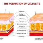 Cellulit - domowe sposoby i zabiegi lecznicze cellulit